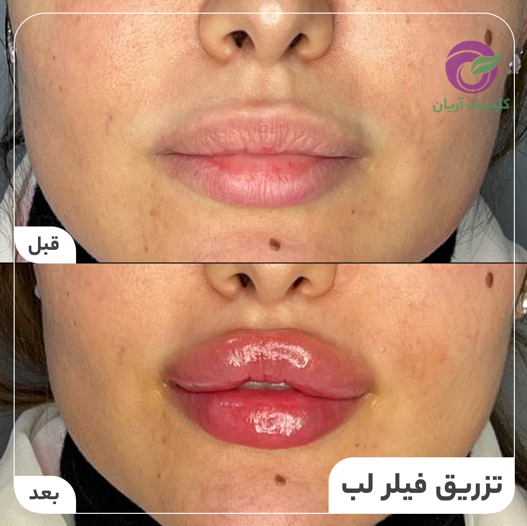 تصاویر قبل و بعد از تزریق ژل